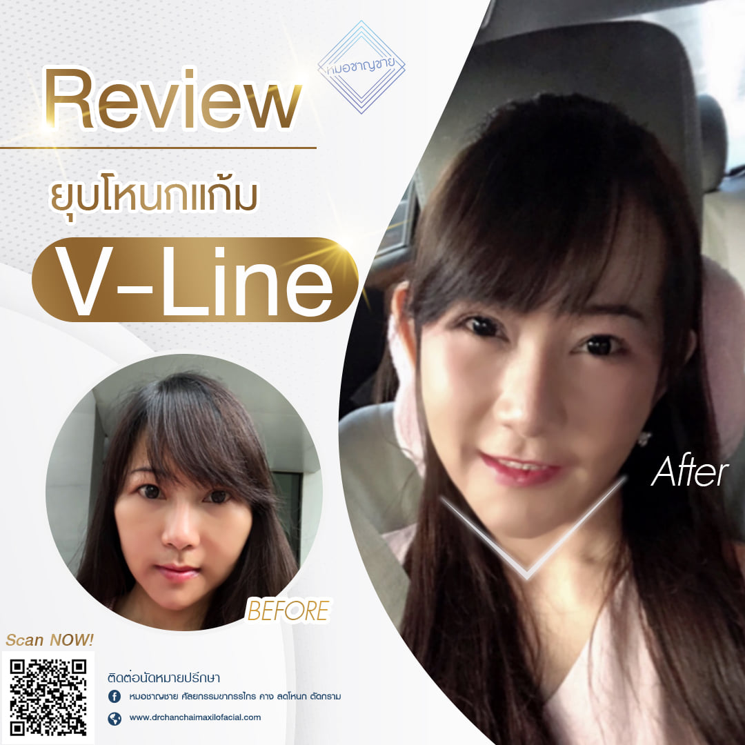 เคส ผ่าตัดยุบโหนกแก้ม V-LINE