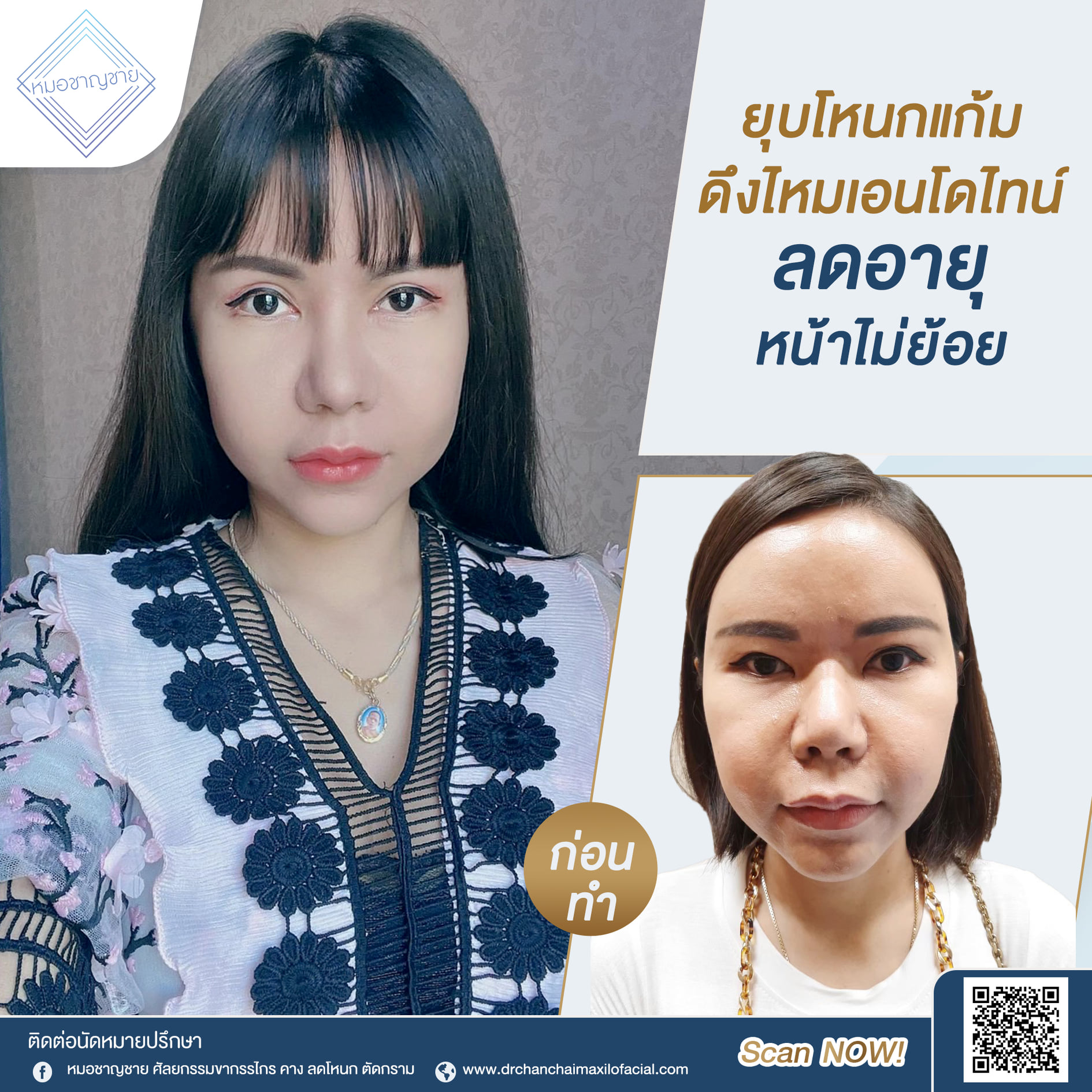 ยุบโหนกแก้ม ดึงไหมเอนโดไทน์