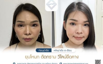 ผ่าตัดยุบโหนกแก้มตัดกราม V-Line