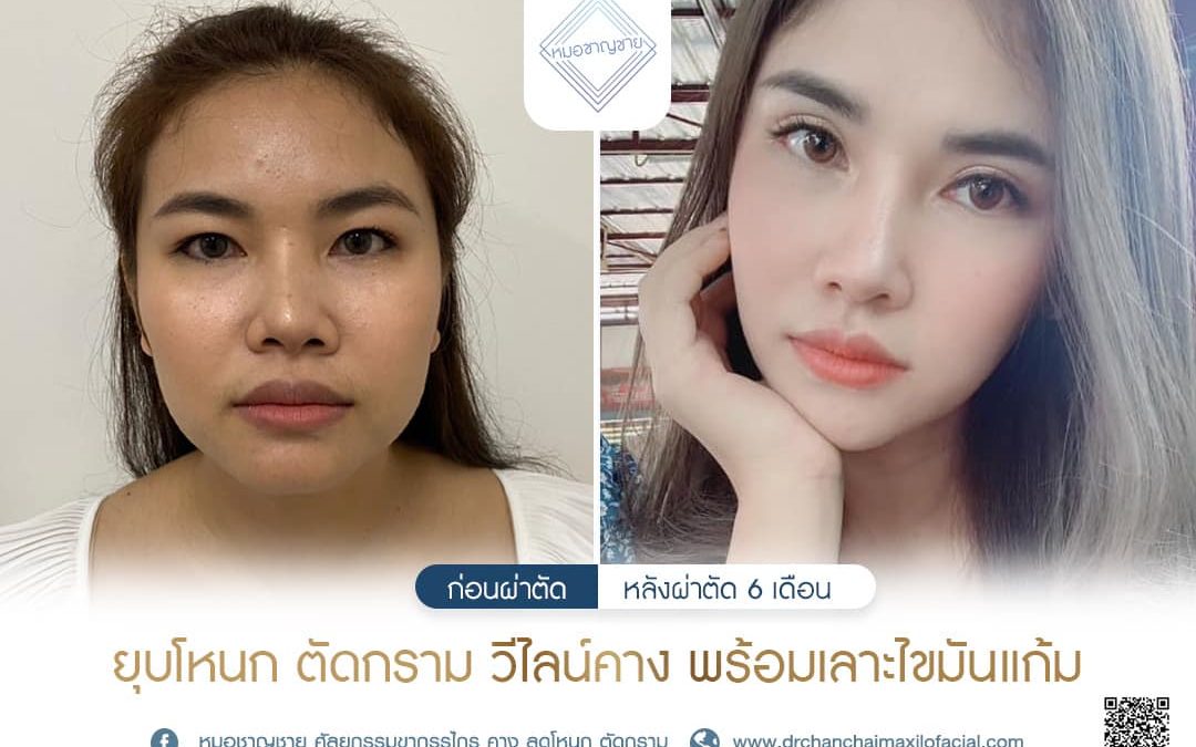 ยุบโหนก ตัดกราม  V-LINE พร้อมเลาะไขมันแก้ม