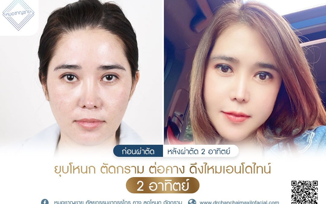 รีวิว ยุบโหนก ตัดกราม ต่อคาง ดึงไหมเอนโดไทน์