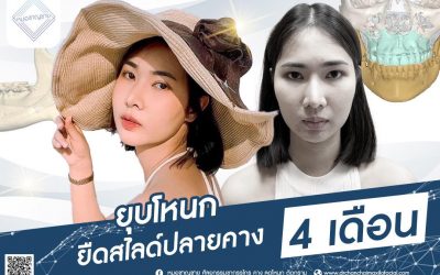 เคส ผ่าตัดยุบโหนกแก้ม ยืดสไลด์ปลายคาง