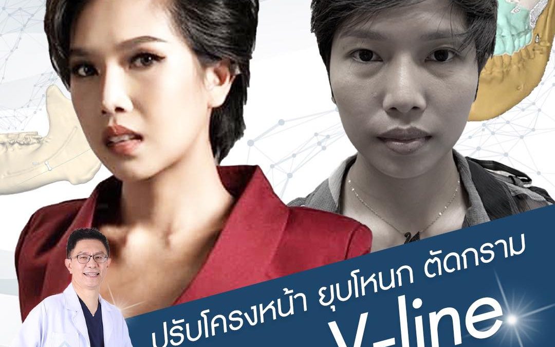 ผ่าตัดยุบโหนกแก้มตัดกราม V-Line