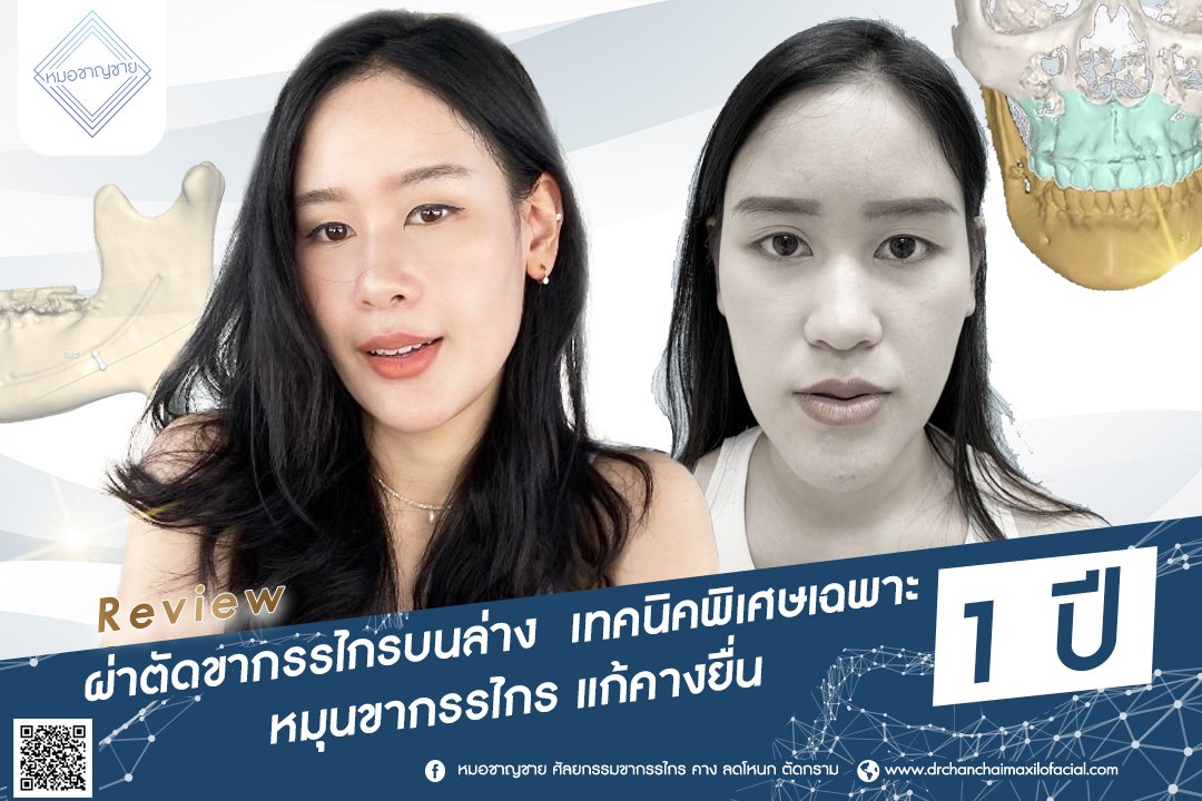 รีวิวผ่าตัดขากรรไกรบนล่าง