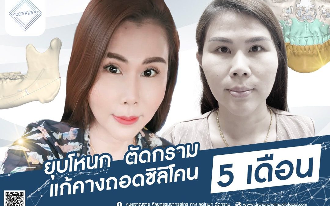 โครงหน้ามาจะครบ 6 เดือน