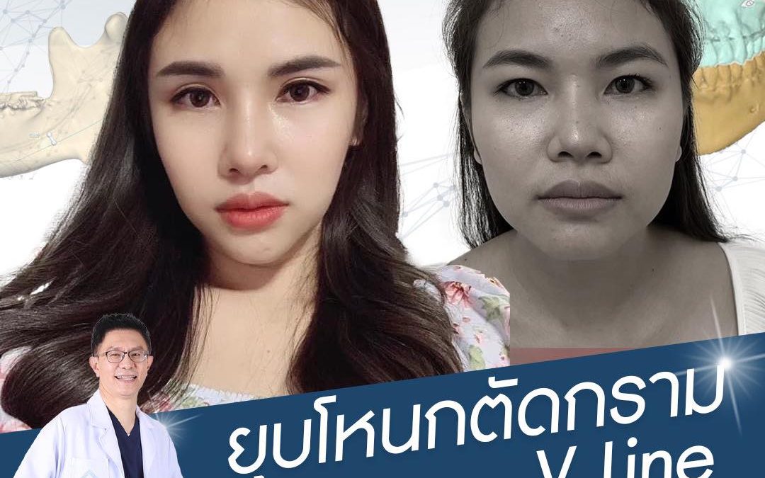 ยุบโหนก ตัดกราม  V-LINE พร้อมเลาะไขมันแก้ม