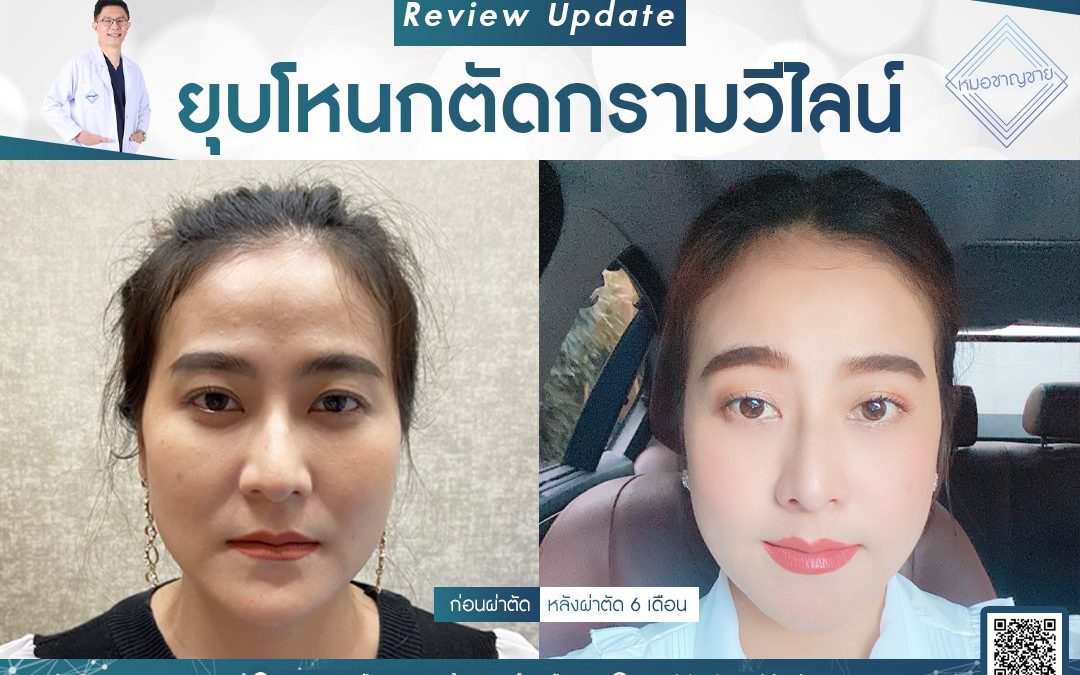 รีวยุบโหนก ตัดกรามวีไลน์ (แก้คางยื่นยาวด้วย)