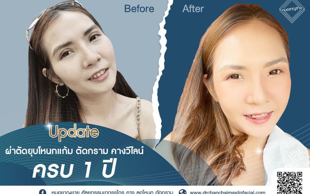 ผ่าตัดยุบโหนกแก้ม ตัดกราม คางวีไลน์