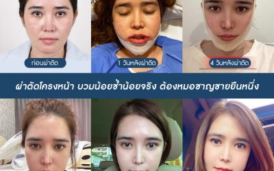 ยุบโหนก ตัดกราม ต่อคาง ดึงไหมเอนโดไทน์