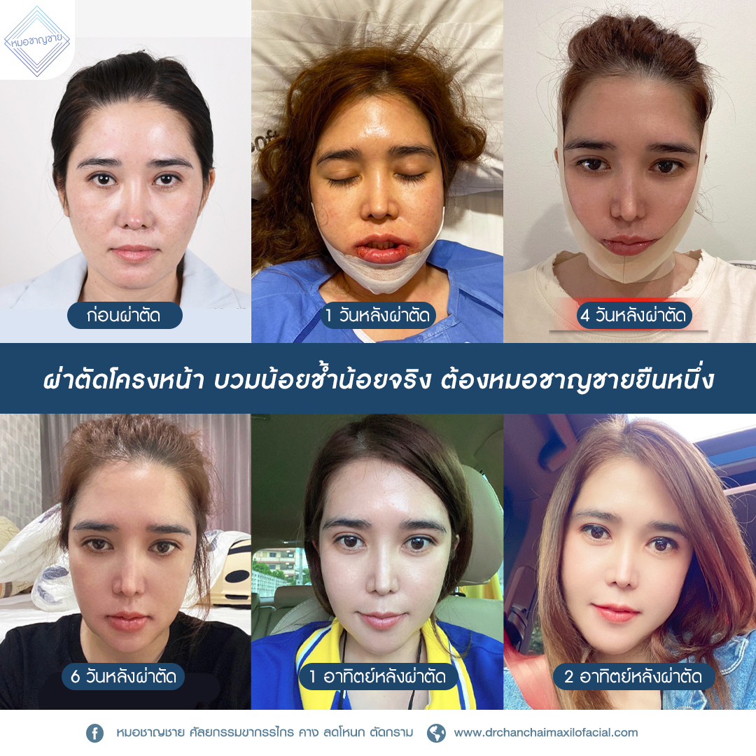 ยุบโหนก ตัดกราม ต่อคาง ดึงไหมเอนโดไทน์ - Dr.Chanchai