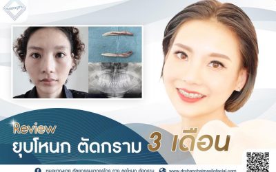 รีวิวยุบโหนก ตัดกราม