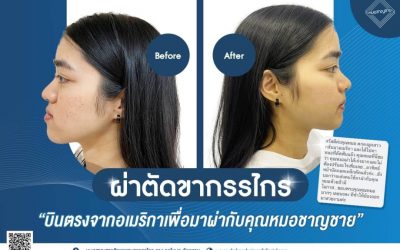 รีวิวผ่าตัดขากรรไกร คุณแม่สุดปลื้ม คุณลูกสุดปัง