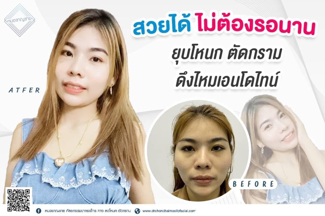 ยุบโหนก ตัดกราม ดึงไหมเอนโดไทน์