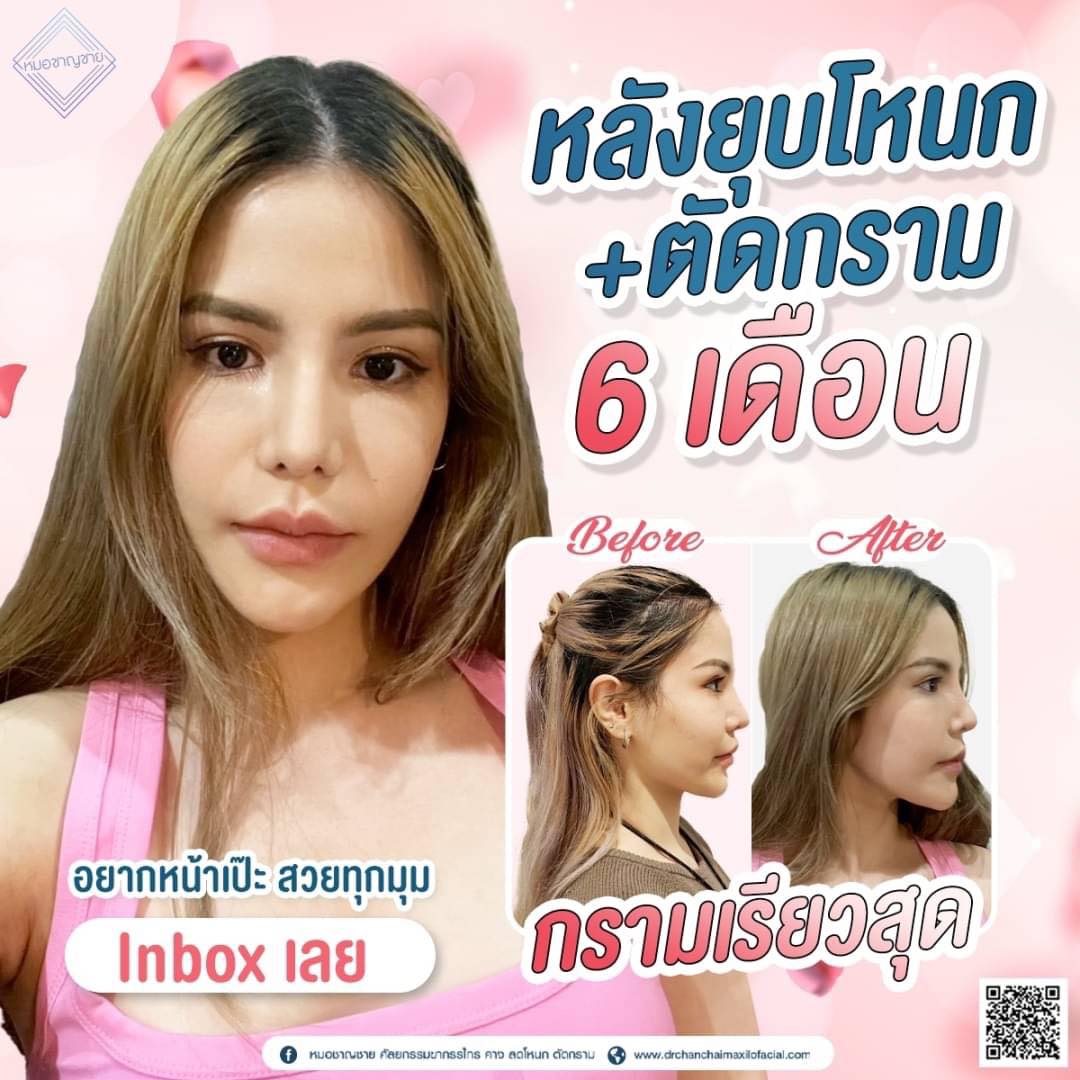 ยุบโหนก ตัดกราม