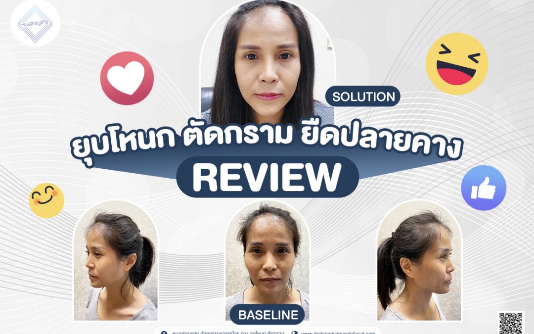 รีวิว ยุบโหนกแก้ม ตัดกราม ยืดปลายคาง