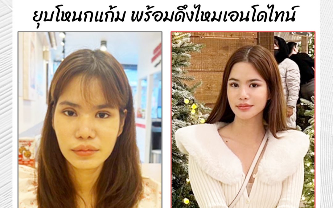 ยุบโหนกแก้ม พร้อมดึงไหมเอนโดไทน์