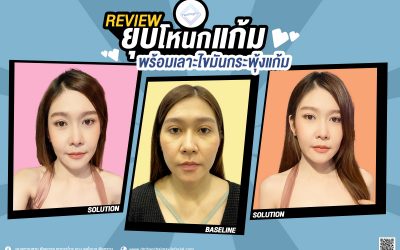 REVIEW ยุบโหนกแก้ม เลาะไขมันกระพุ้งแก้ม