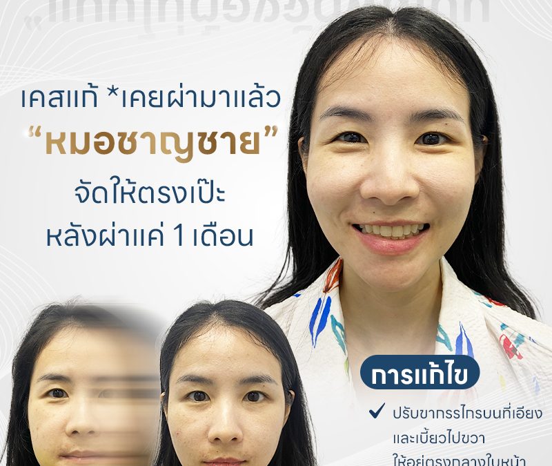 รีวิวผ่าตัดขากรรไกร