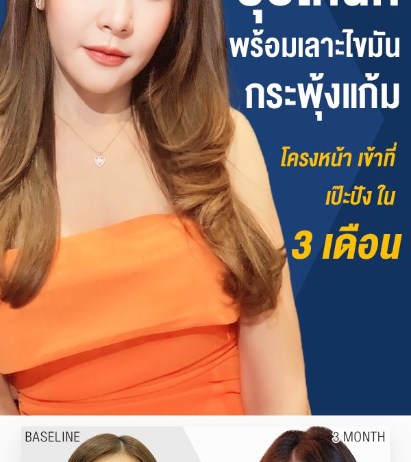 Updateยุบโหนก พร้อมเลาะไขมันกระพุ้งแก้ม