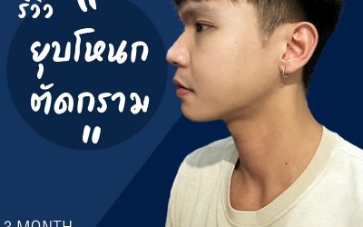 รีวิวยุบโหนก ตัดกราม ใน 3 เดือน