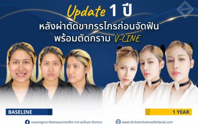 หลังผ่าตัดขากรรไกรก่อนจัดฟัน พร้อมตัดกราม V-LINE