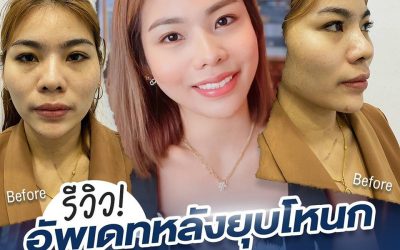 รีวิว! อัพเดทหลังยุบโหนก ตัดกราม