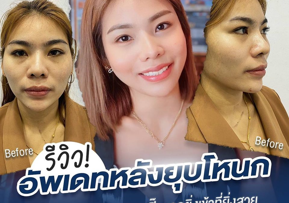 รีวิว! อัพเดทหลังยุบโหนก ตัดกราม