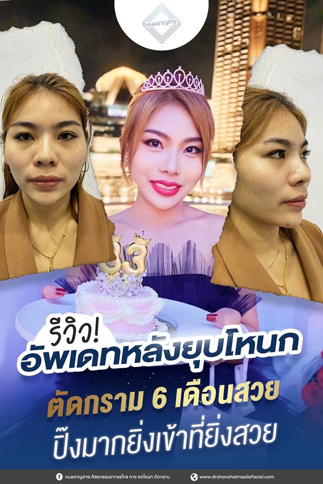 ยุบโหนก