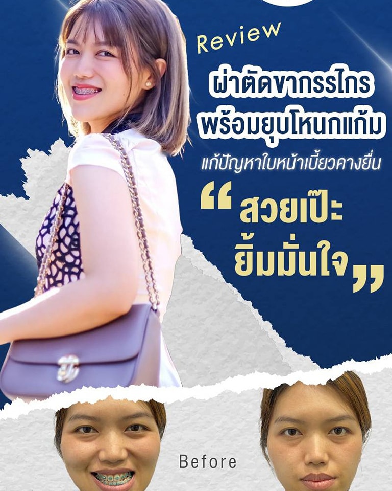 ผ่าตัดขากรรไกร พร้อมยุบโหนกแก้ม