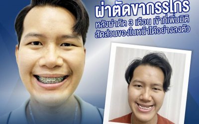 รีวิว! ผ่าตัดขากรรไกร