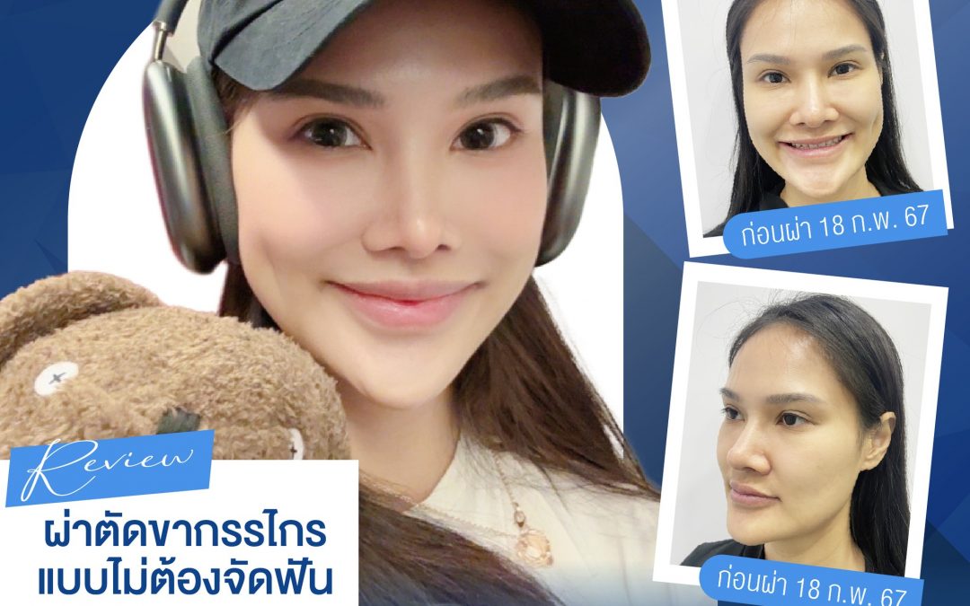 รีวิวผ่าตัดขากรรไกร แบบไม่ต้องจัดฟัน