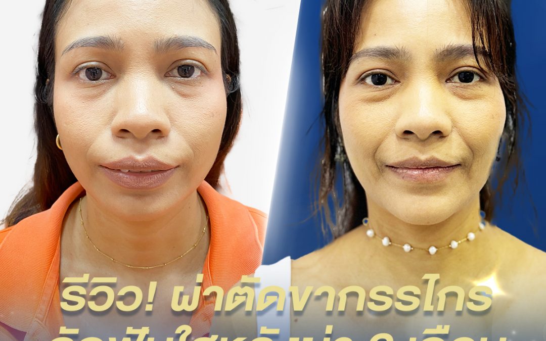 รีวิวผ่าตัดขากรรไกรร่วมกับการจัดฟัน แบบจัดฟันใส