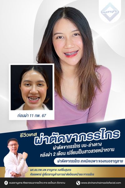 รีวิวผ่าตัดขากรรไกร เทคนิคเฉพาะหมอชาญชาย